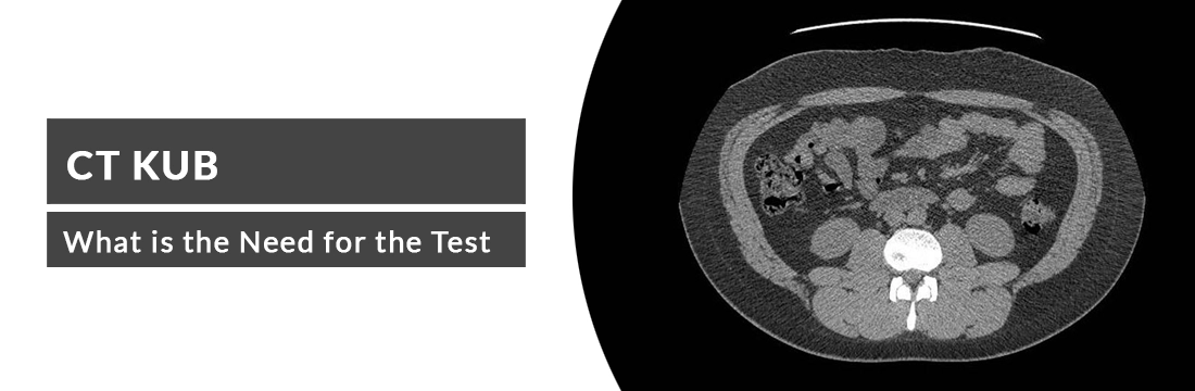 CT KUB: What is the Need for the Test